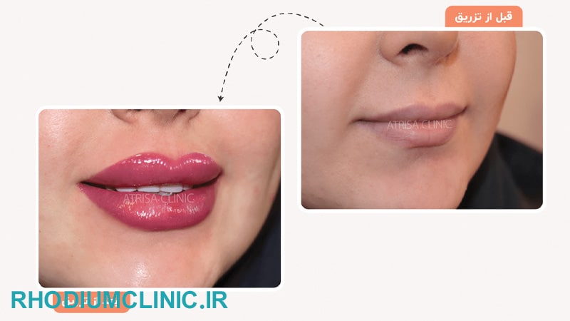 اتریسا 1