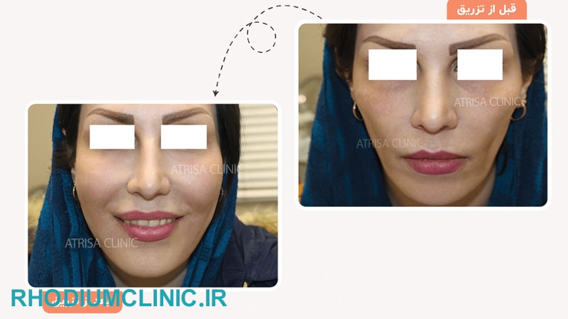 اتریسا 2
