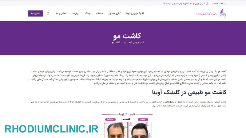 مرکز کاشت مو آوینا در تهران
