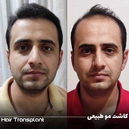 کلینیک کاشت مو تهران نوین