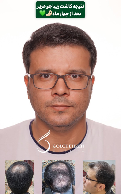 مرکز کاشت مو گلچهره در تهران