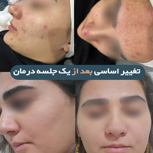 فیشیال پوست صورت در کرج