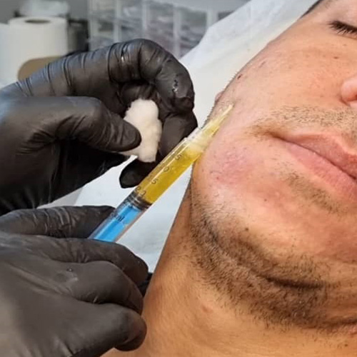 تزریق PRP در کرج