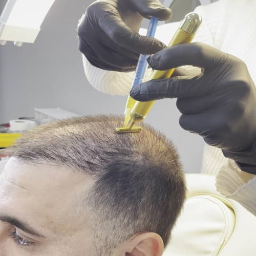 تزریق PRP مو در کلینیک نیلوفر