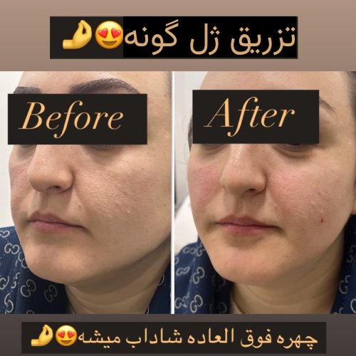 تزریق ژل گونه توسط دکتر نرگس اخوان