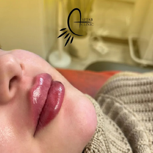 بهترین دکتر تزریق ژل لب در کرج