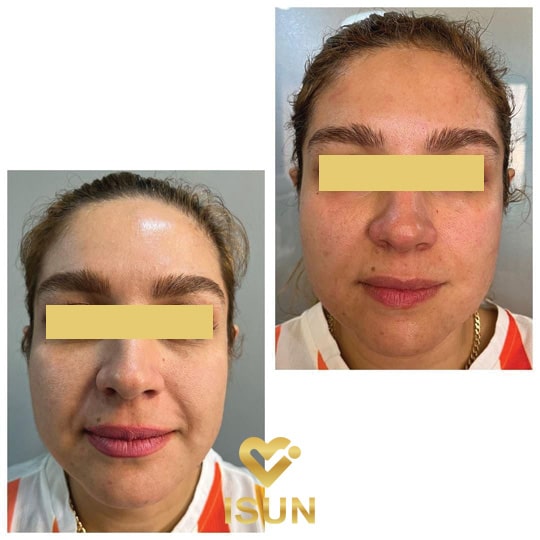 فیشیال پوست در کلینیک آیسان کرج
