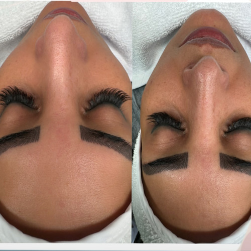 فیشیال صورت در کرج