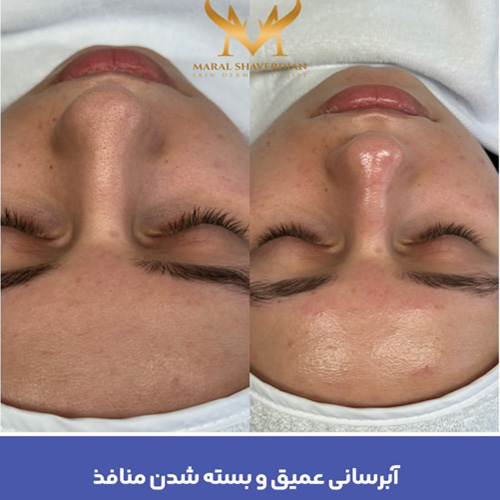 فیشیال صورت در کرج