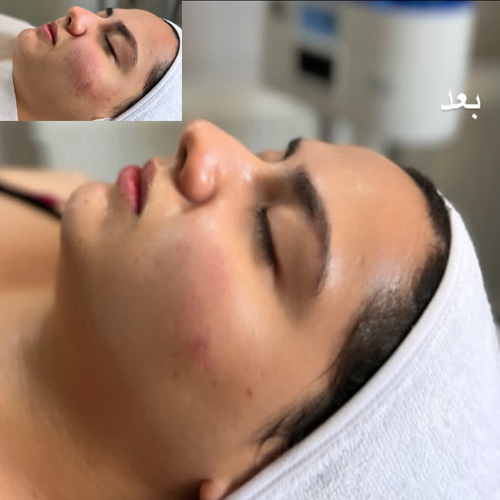 فیشیال پوست در کرج