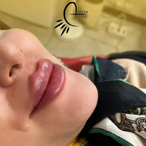 تزریق ژل لب در کرج با قیمت مناسب