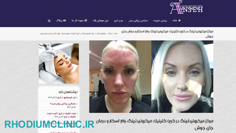 آنسه، مرکز مزونیدلینگ در کرج