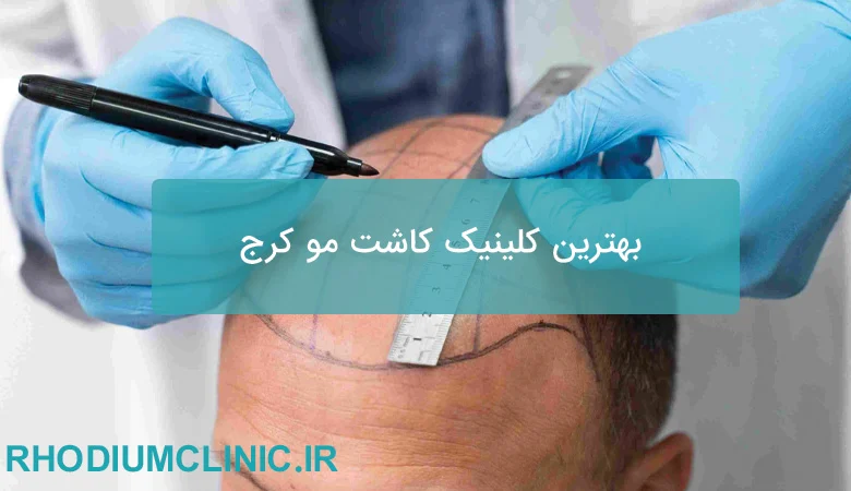 بهترین کلینیک کاشت مو کرج