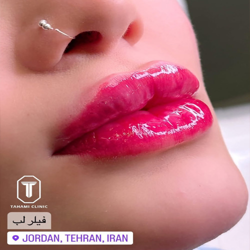 تهامی، بهترین کلینیک تزریق ژل در تهران