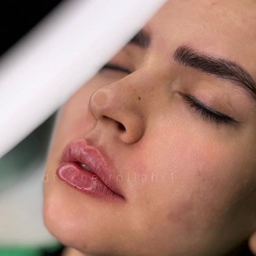 دکتر علیرضا خیرالهی، بهترین دکتر تزریق ژل لب در تهران