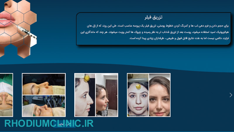 علی شفیعی، دکتر تزریق فیلر در تهران