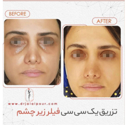 بهترین دکتر تزریق فیلر در تهران