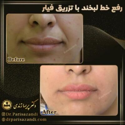 مرکز تزریق فیلر دکتر پریسا زندی تهران