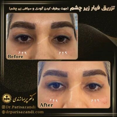 مرکز تزریق فیلر دکتر پریسا زندی در تهران