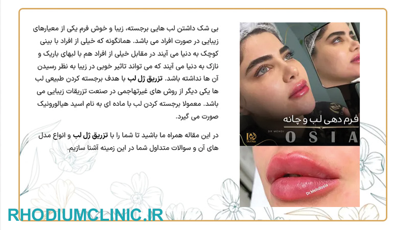 مرکز تزریق ژل لب دکتر مهدی اوصیا در تهران