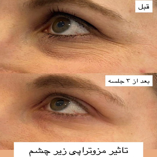 مزوتراپی در کلینیک زیبایی هروی