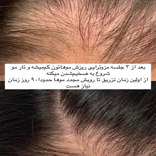 مزوتراپی مو در کلینیک زیبایی هروی