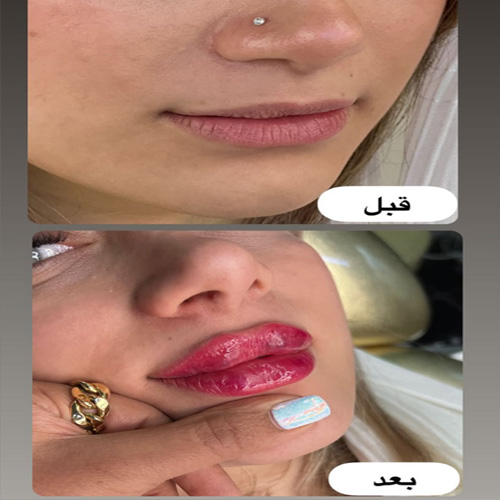 دکتر مهسا عماد، بهترین دکتر تزریق ژل در تهران