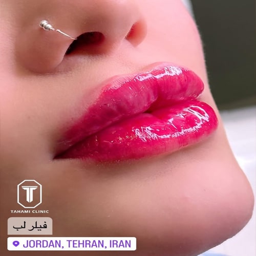 نمونه کار دکتر تهامی، برای تزریق فیلر