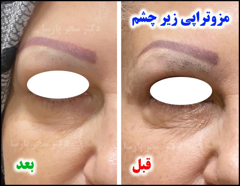 نمونه کار مزوتراپی