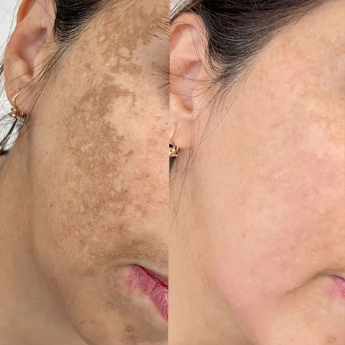 پاکسازی صورت در کلینیک زیبایی هروی