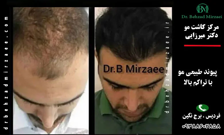 نمونه کار کاشت مو کلینیک دکتر میرزایی