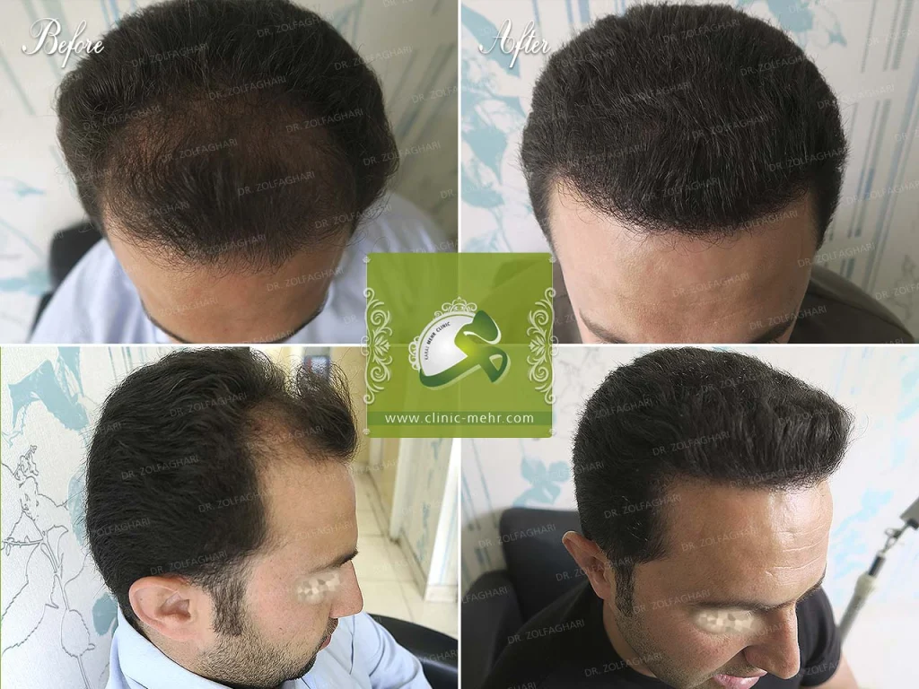 نمونه کار کاشت مو کلینیک مهر