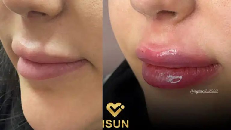 نمونه کار کلینیک آیسان برای تزریق فیلر در کرج