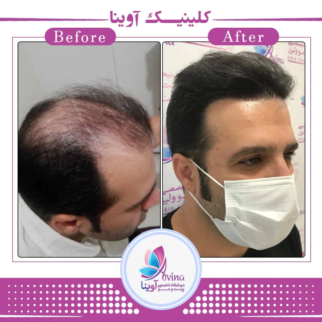 نمونه کاشت مو کلینیک آوینا
