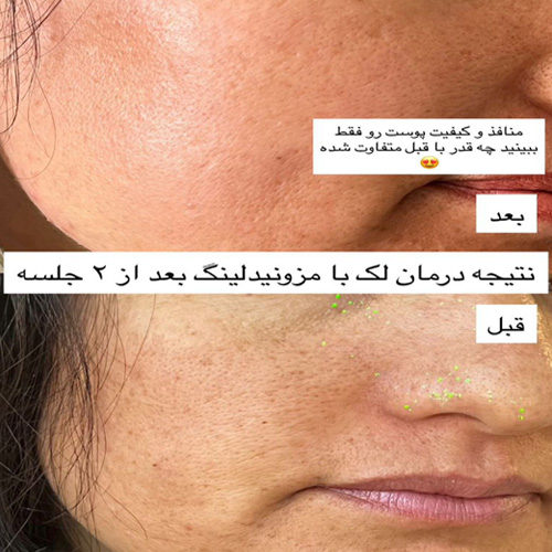 نمونه کار پاکسازی صورت کلینیک هروی