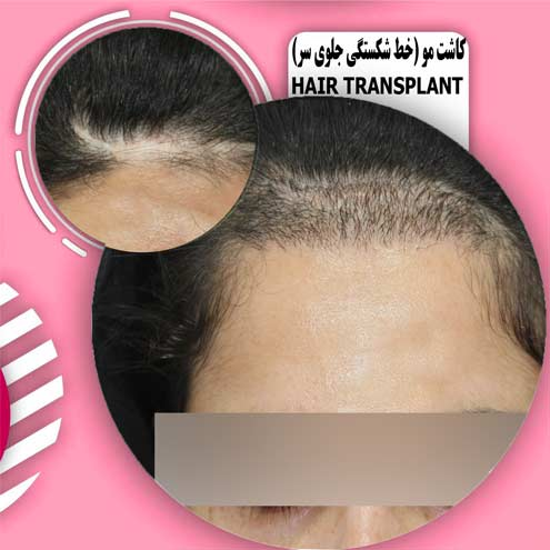 کاشت مو در کرج کلینیک آسمان آبی