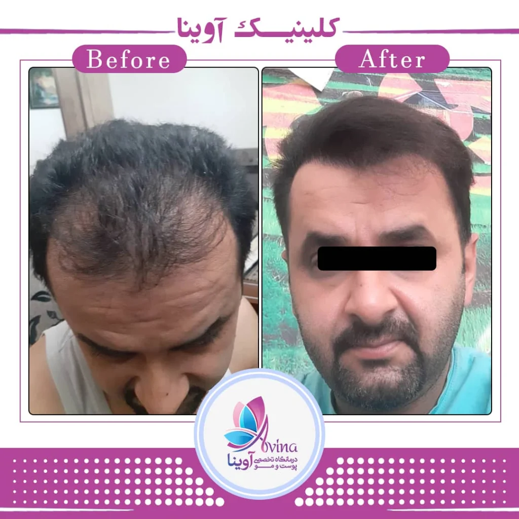 کاشت مو کلینیک آوینا
