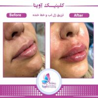 کلینیک تزریق ژل آوینا در تهران