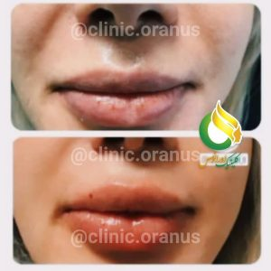 کلینیک تزریق ژل اورانوس در تهران
