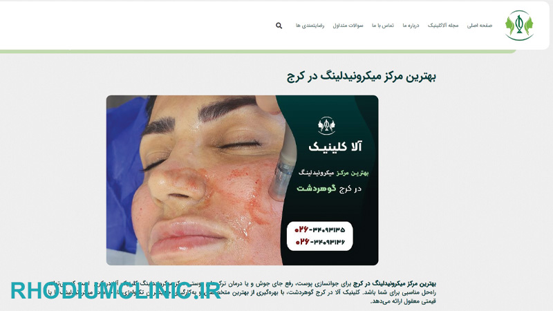 کلینیک میکرونیدلینگ آلا در کرج
