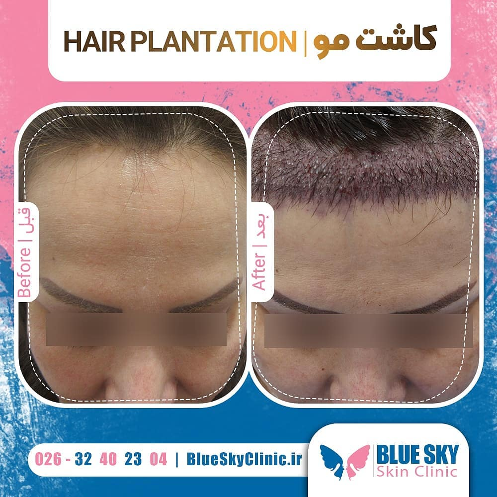 کلینیک کاشت مو آسمان آبی کرج