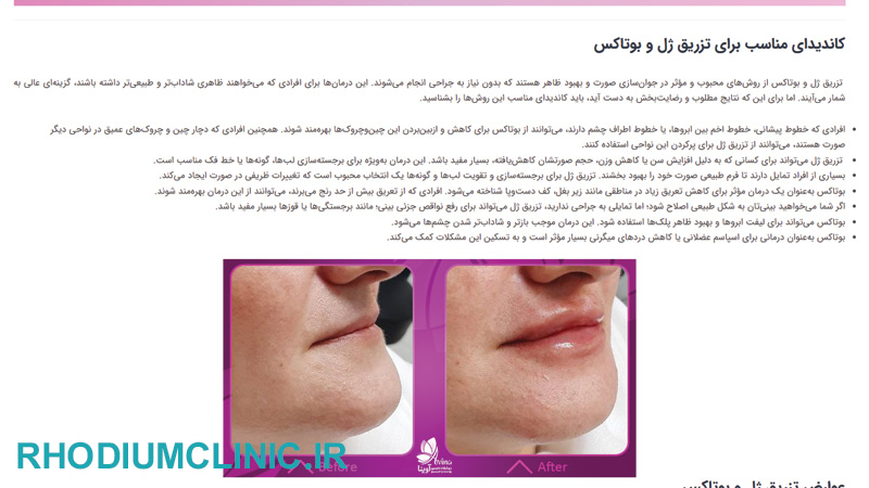 آوینا، یکی از بهترین مراکز تزریق ژل گوهردشت