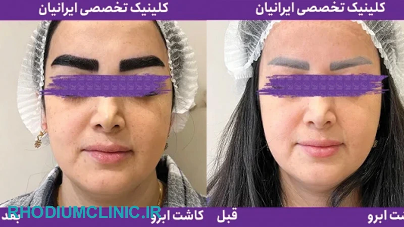 ایرانیان، بهترین مرکز کاشت ابرو در تهران