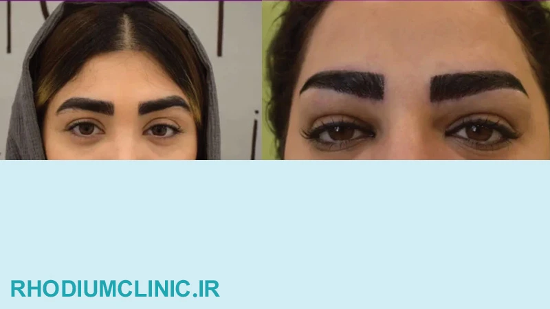 دکتر محمد جلالیان دکتر کاشت ابرو در تهران