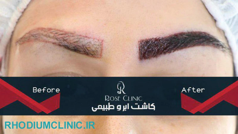 کلینیک کاشت ابرو رز در تهران