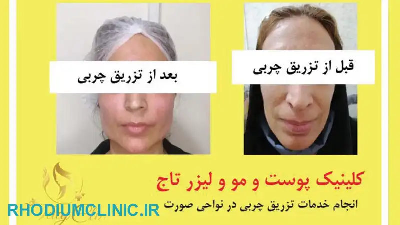 مرکز تزریق چربی تاج در کرج