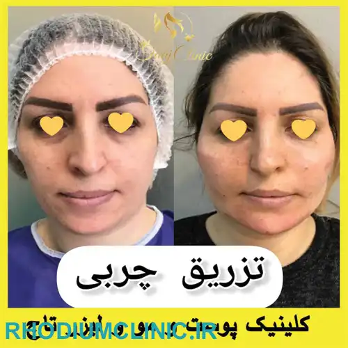 مرکز تزریق چربی تاج در کرج