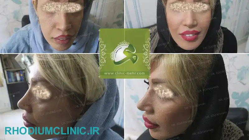 مرکز تزریق چربی مهر در کرج