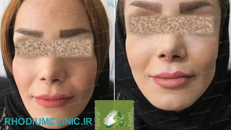 مرکز تزریق چربی مهر کرج