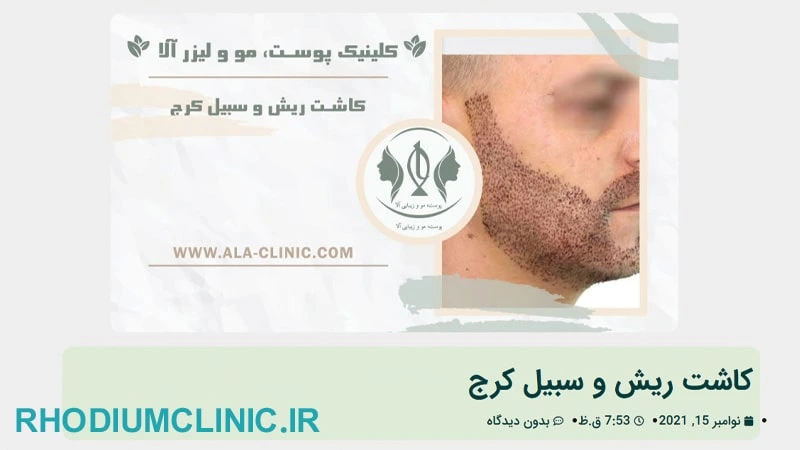 مرکز کاشت ریش و سبیل آلا در کرج